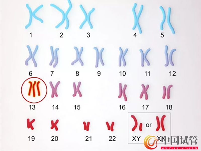 唐氏綜合征21號異常染色體引發的危害(圖1)